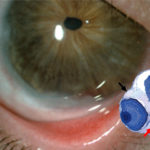 glaucoma_ojopaciente_estudio_embrionpezcebra